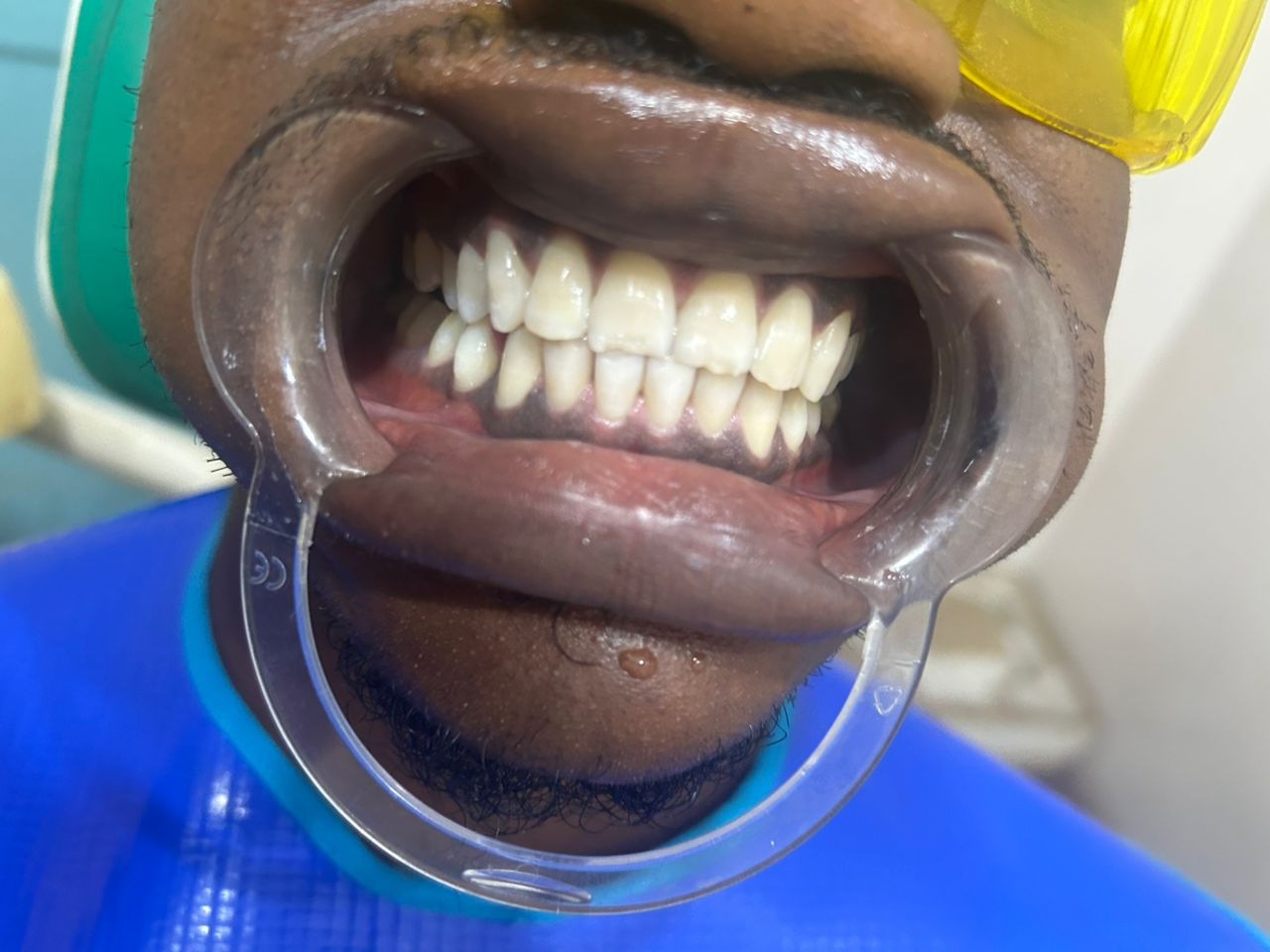 Same patient's teeth after professional whitening treatment